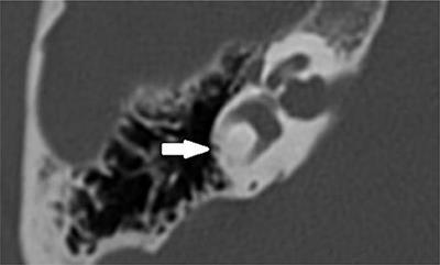 Correlations Between Vestibular Function and Imaging of the Semicircular Canals in DFNA9 Patients